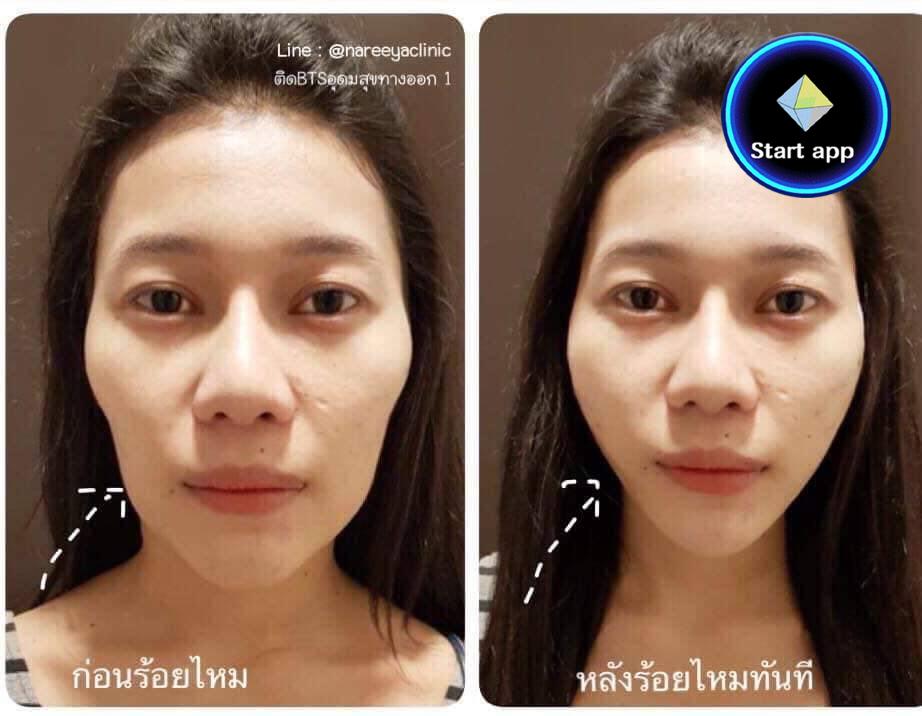 โปรโมชั่น ปรับรูปหน้า